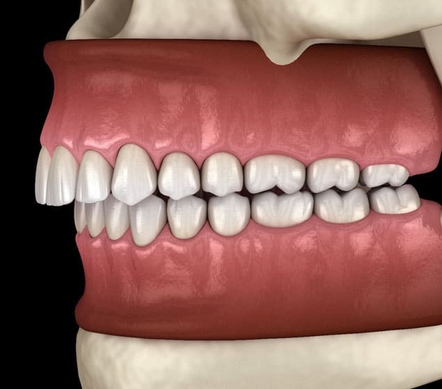 Class II malocclusion showing upper front teeth overlapping lower teeth in side view.