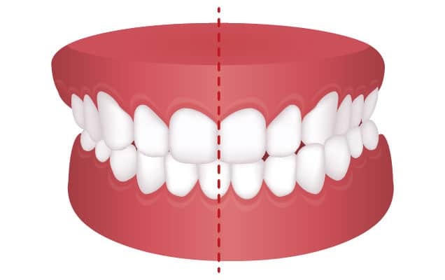 Dental model showing teeth misalignment with a center line indicating asymmetrical bite.