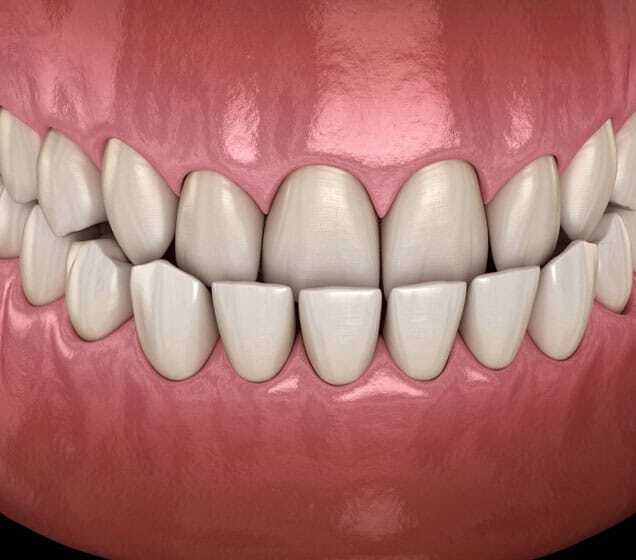 3D illustration of an underbite showing misaligned upper and lower teeth in need of orthodontic treatment.