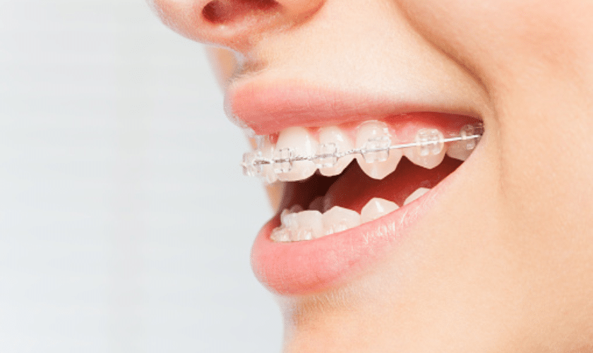 Close-up of a patient's smile showing clear dental braces on upper and lower teeth.