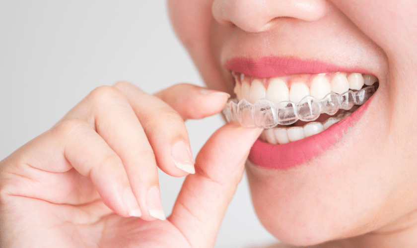 Woman inserting clear Invisalign aligner over her teeth to straighten her smile.