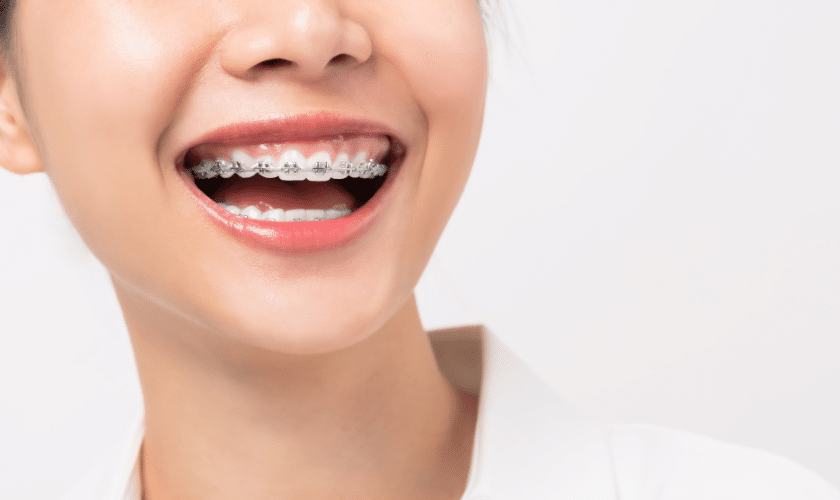 Young patient smiling with metal braces showing orthodontic treatment progress.