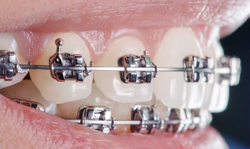 Close-up view of metal braces on upper and lower teeth showing orthodontic brackets and wires.
