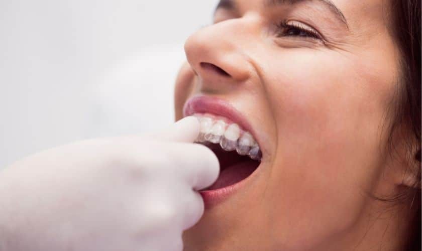 Patient displaying clear aligners during Invisalign treatment in Woodbury, MN.