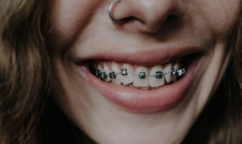 Close-up of a smiling patient with metal braces on upper teeth.
