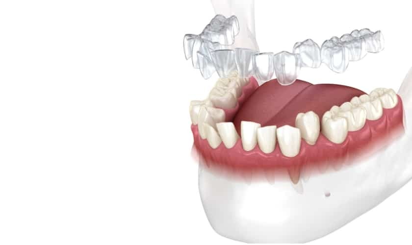3D illustration of Invisalign clear aligners positioned over a dental model showing teeth alignment.
