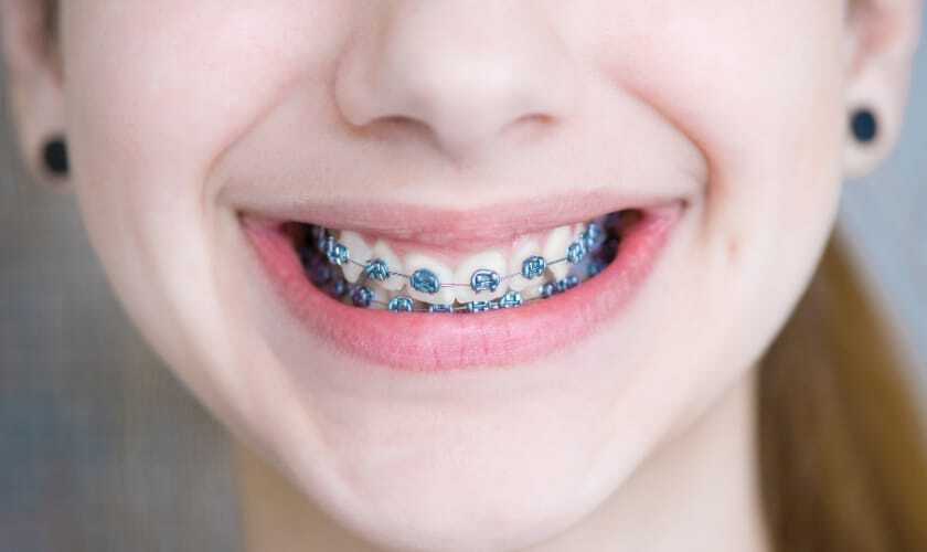 Close-up of a smiling patient wearing blue metal braces on teeth.