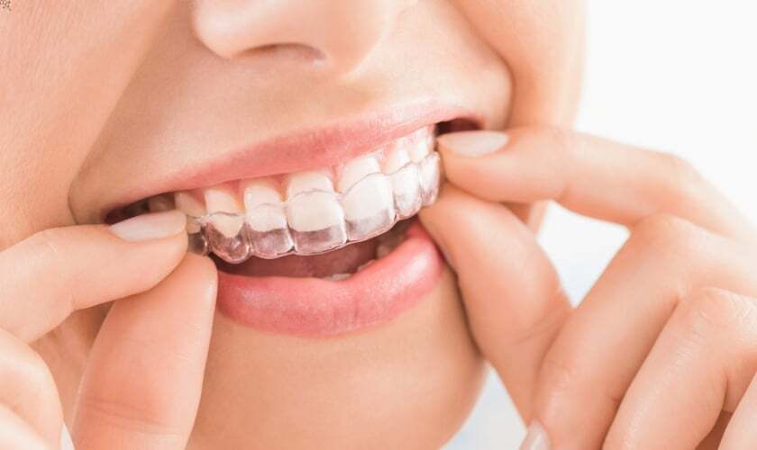 invisalign