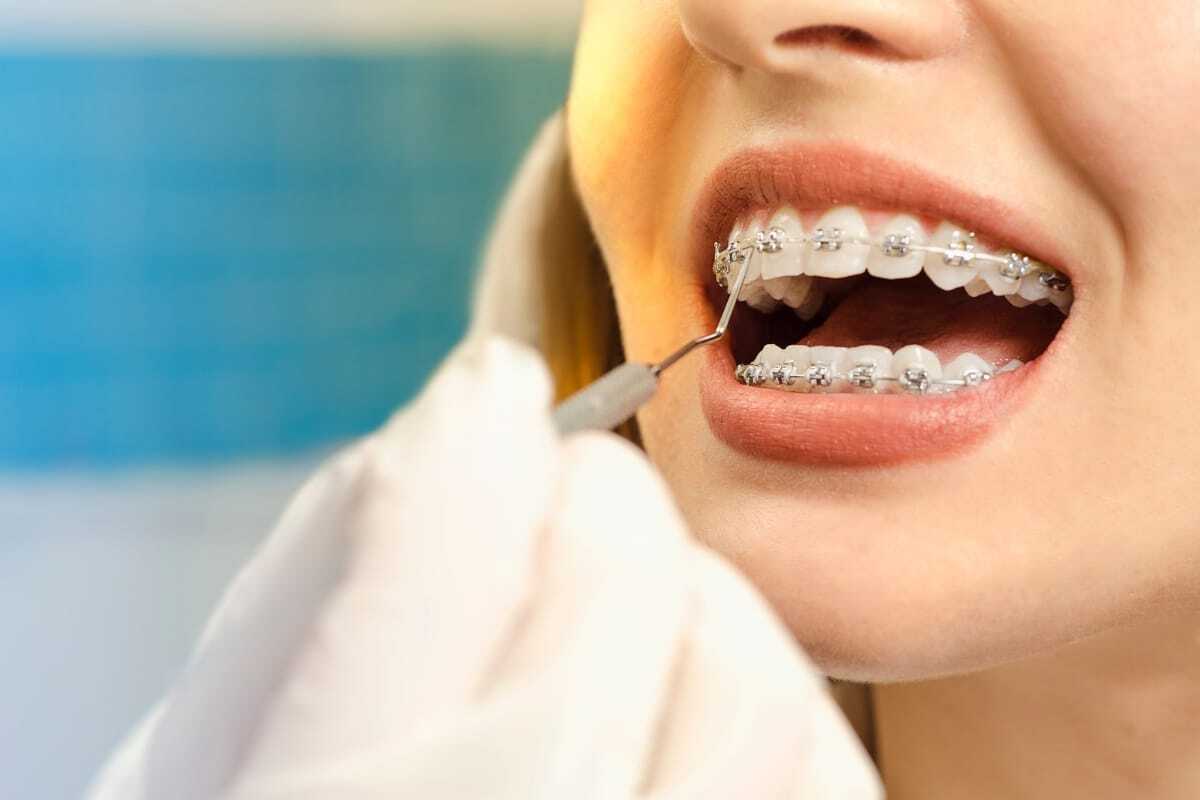 Patient with metal braces smiling, showing orthodontic treatment results.