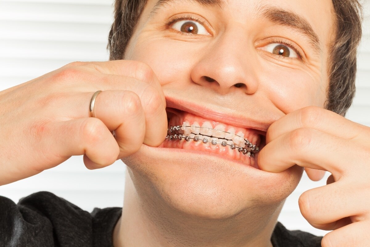 Man examining broken braces wire on his teeth during dental emergency.