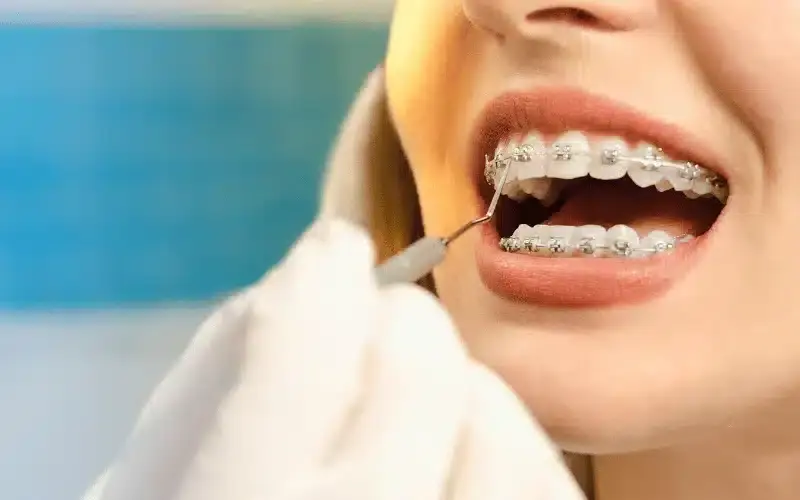 Close-up of patient with metal braces smiling during dental examination with mirror tool.