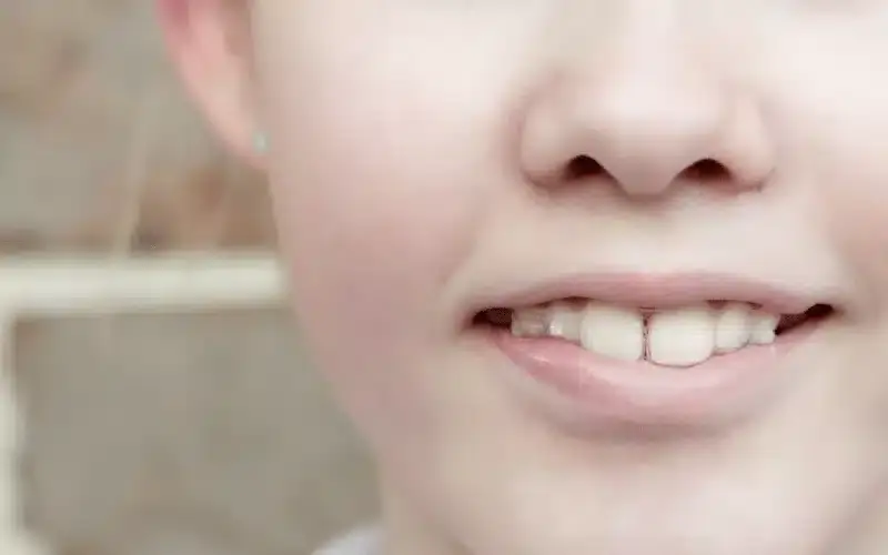 Close-up of a patient's smile showing straight, white teeth and healthy gums.