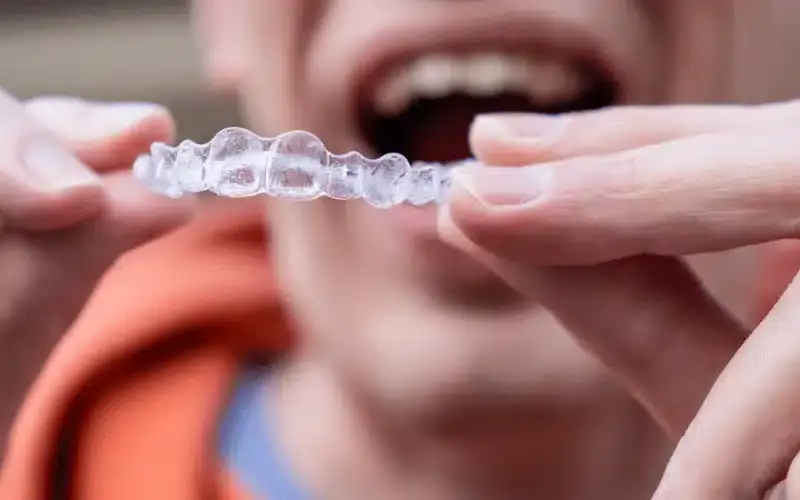 Person holding a clear Invisalign aligner tray showing tooth gap closure treatment.