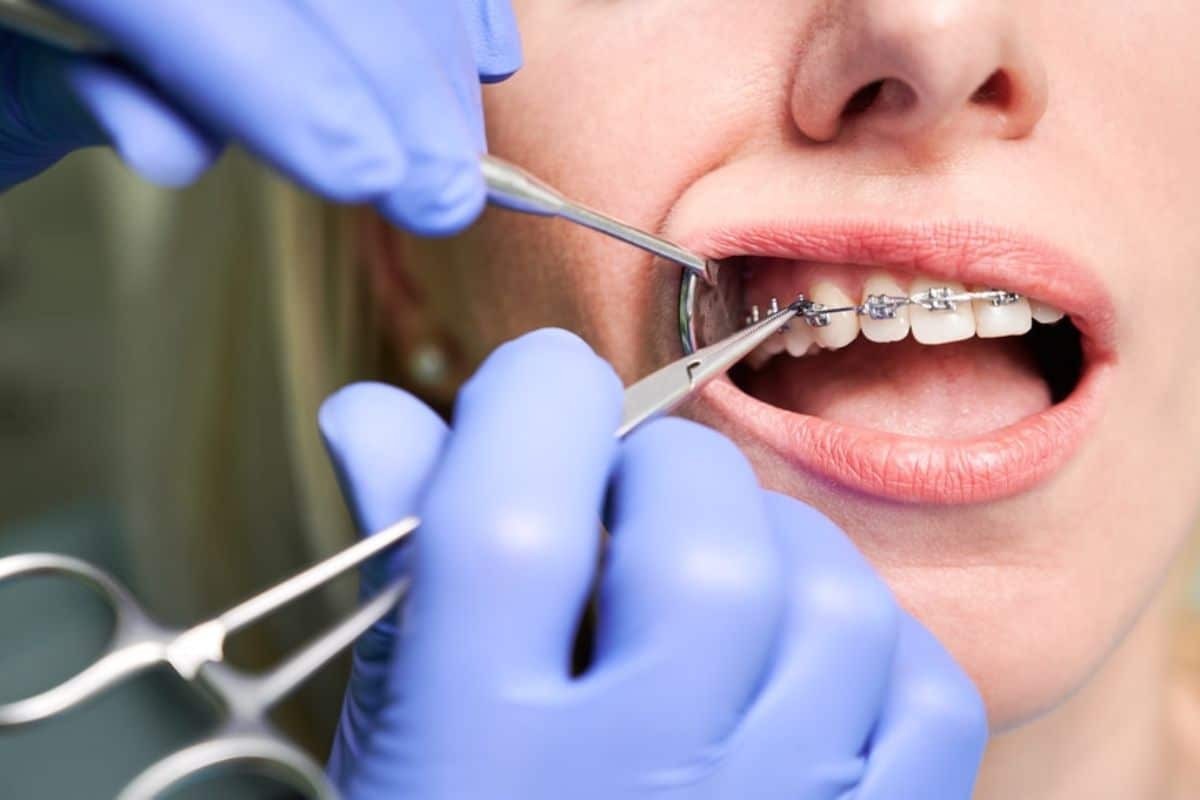 Dentist removing braces from patient's teeth with dental tools during bracket removal procedure.
