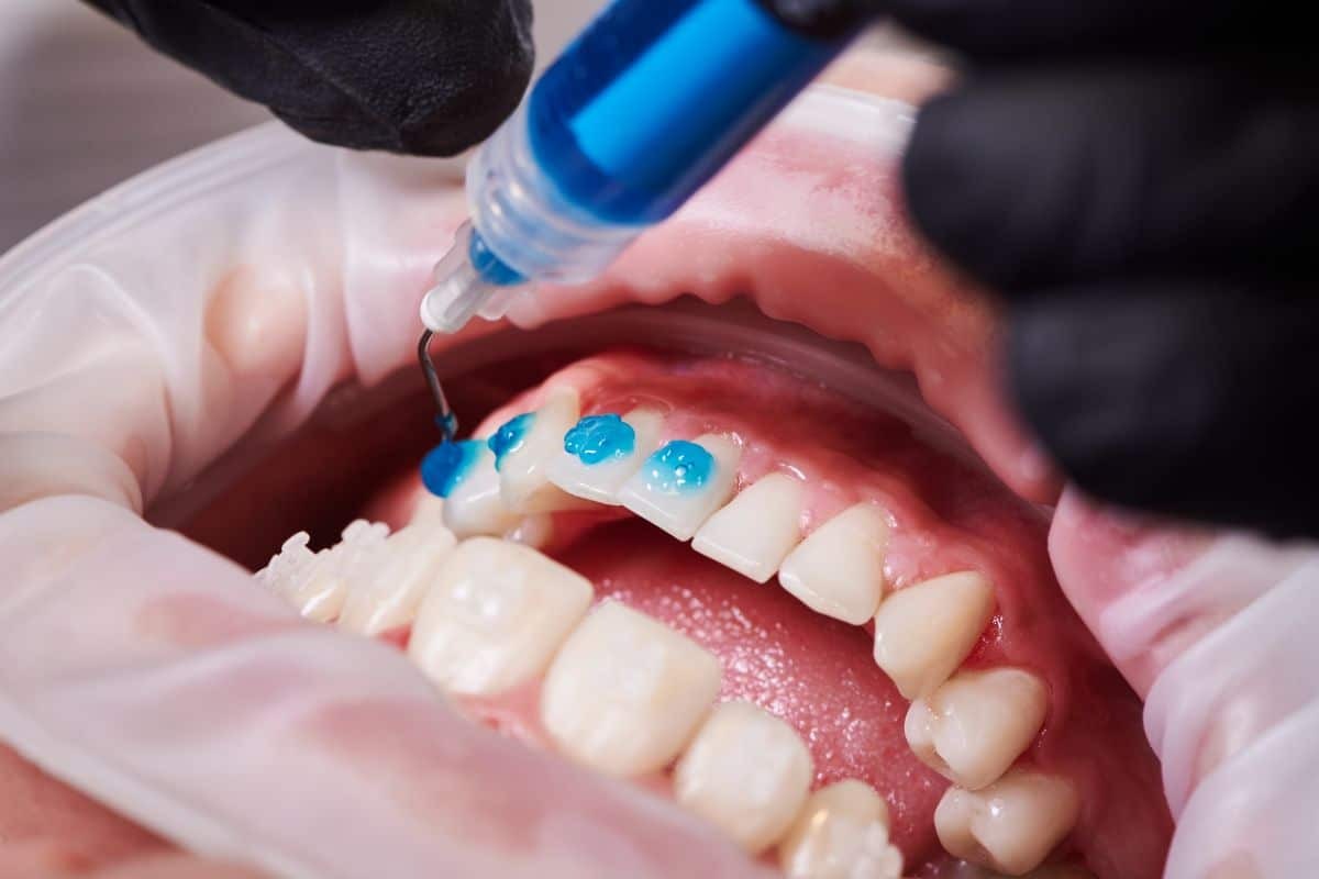 Dentist applying blue dental bonding material to patient's front teeth during braces treatment.