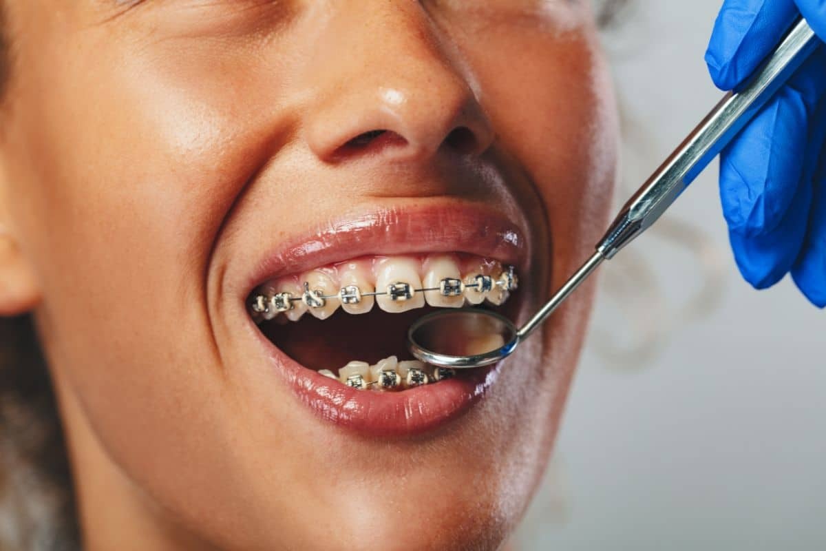 Dentist examining patient's teeth with clear braces during orthodontic treatment.