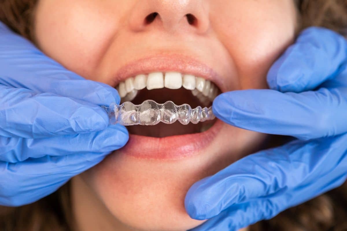 Dentist inserting clear aligner into patient's mouth during treatment.