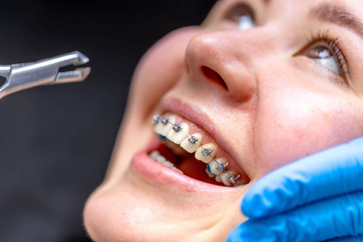 Close-up of patient with metal braces during dental examination and adjustment.
