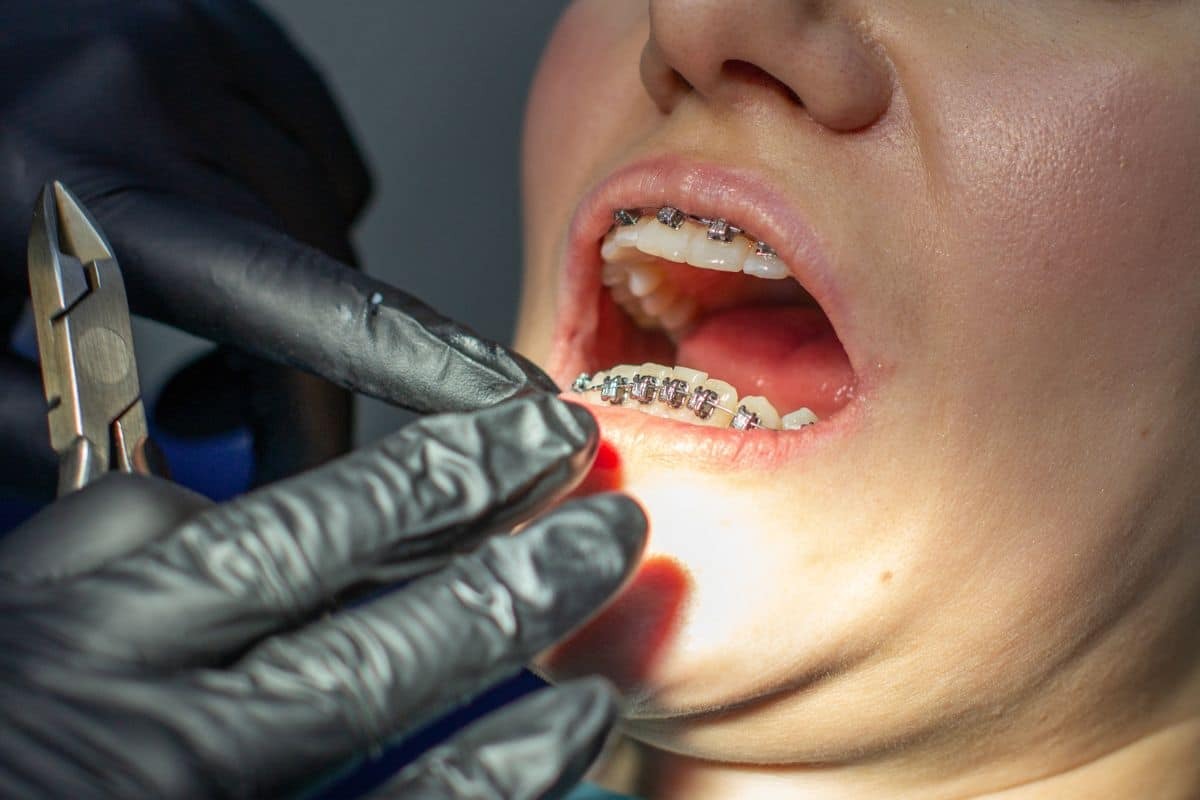 Orthodontist examining patient's braces during dental treatment in Woodbury, MN.
