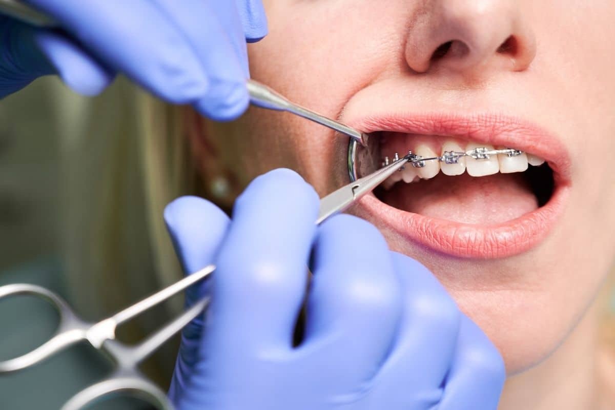 Dentist examining patient's metal braces on front teeth during orthodontic treatment.