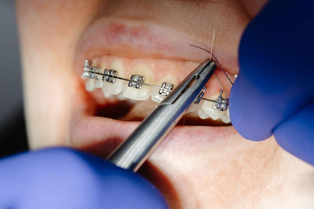 Orthodontist using ultrasonic scaler to clean teeth during braces treatment appointment.