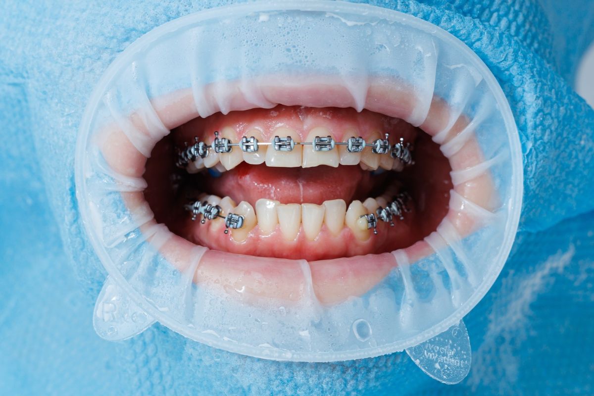 Featured image for “Braces After 40: Is It Too Late to Correct Years of Crooked Teeth?”