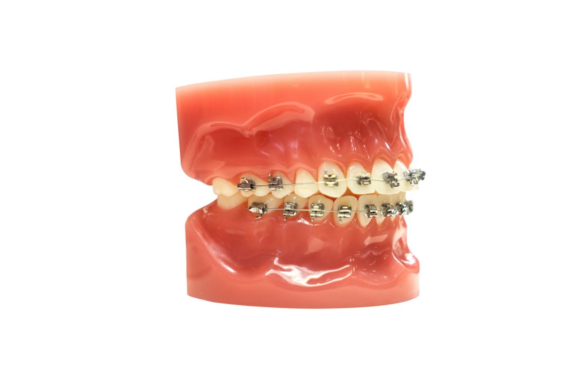 crowded teeth treatment