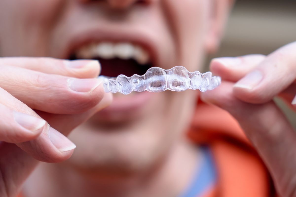 Featured image for “Can Invisalign Fix an Overbite, or Do You Really Need Braces?”