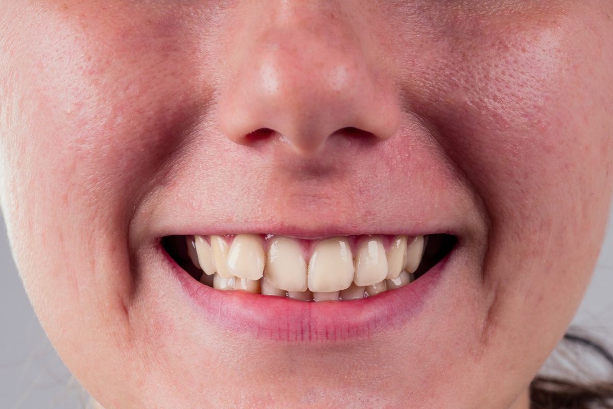 Featured image for “One Tooth Sticking Out? When a Small Alignment Problem Needs Attention”